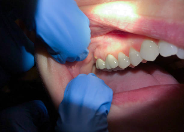 Best Emergency Dental Services for Seniors in Choccolocco, AL