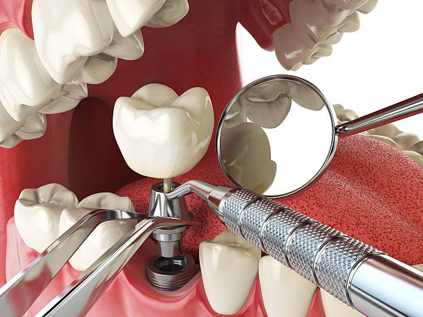 Best Emergency Dentist for Knocked-Out Tooth in Choccolocco, AL